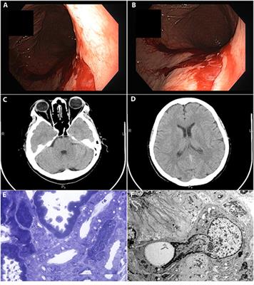 Case Report: Hyponatremia Secondary to <mark class="highlighted">Desmopressin</mark> Administration Prior to Percutaneous Kidney Biopsy: A Case-Based Review